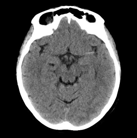 Dense MCA Sign-Hyperacute Infarction Sumer's Radiology Blog, 41% OFF