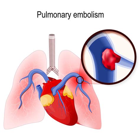 Pulmonary Embolism: What You Need to Know