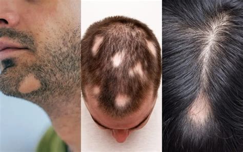 Alopecia Areata: Circular or Patchy Hair Loss