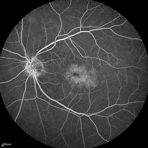 Macular Edema: Causes, Symptoms, & Treatment Options - Venice Retina