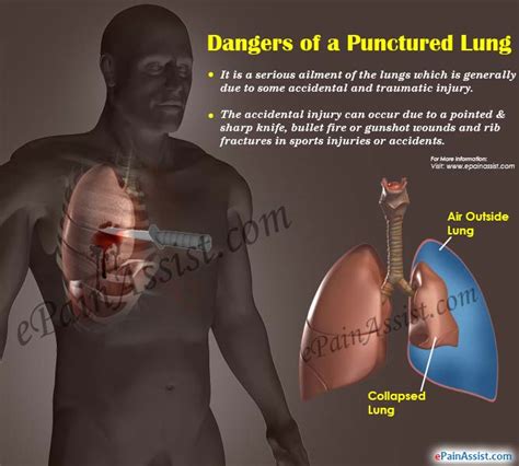 Dangers of a Punctured Lung & its Symptoms and Treatment