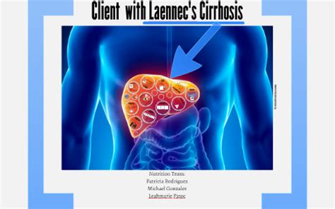 Client with Laennec's Cirrhosis by Leahmarie Patoc on Prezi