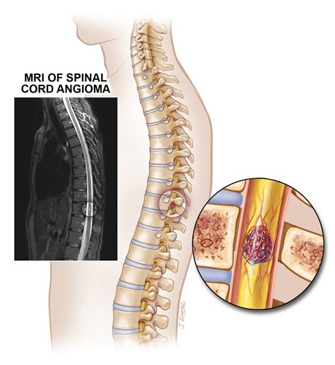 Spinal Cord Lesions - Alliance to Cure Cavernous Malformation