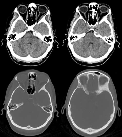 Archives Skull Base Meningioma Embolization MHT Access | neuroangio.org