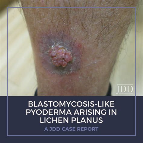 Blastomycosis-like Pyoderma Arising in Lichen Planus - A JDD Case ...