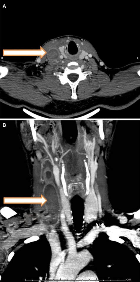 CTA of the neck revealing thrombosis of the right IJV (arrow); (A)... | Download Scientific Diagram