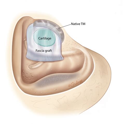 Mastoid Surgery