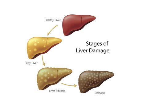 Study Finds Link Between Blood Sugar and Liver Disease Progression ...