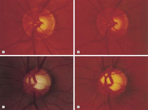 Clinical Factors Associated With Progression of Glaucomatous Optic Disc Damage in Treated ...