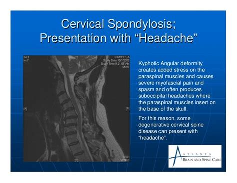 Cervical spondylosis