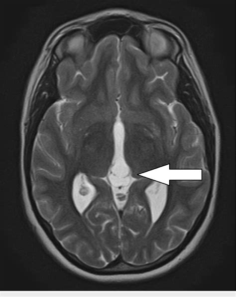 T2-weighted axial magnetic resonance imaging (MRI) demonstrating... | Download Scientific Diagram