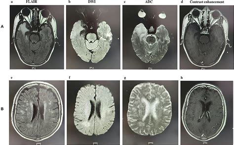 Frontiers | Abnormal Brain MRI Findings in Anti-N-Methyl-D-Aspartate Receptor Encephalitis and ...