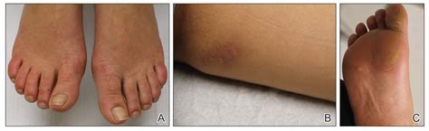 Bothersome Blisters: Localized Epidermolysis Bullosa Simplex | MDedge ...