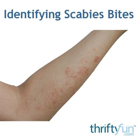 A scabies rash is caused by a microscopic mite and they often start to bite on the feet. This is ...