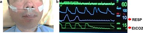 end tidal co2 monitoring waveforms - Glory Lindberg