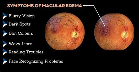 Cystoid Macular Edema (CME) Treatment in Delhi | Causes & Prevention