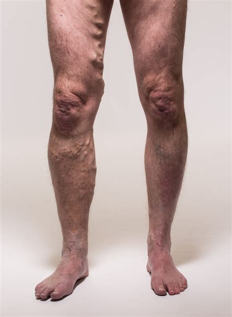 A 73-Year-Old with Lower Extremity Edema: A Comprehensive Approach to Lymphedema - American ...