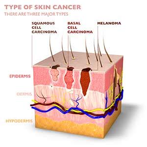 Basal Cell Carcinoma Stages | Moffitt