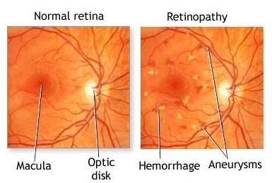 Splinter Hemorrhages Eye