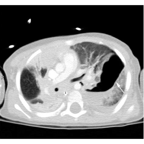 Coronal view on CT chest: a large and irregular pneumatocele extending... | Download Scientific ...