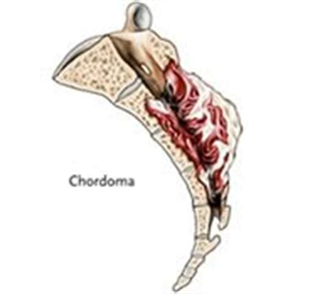 Chordoma