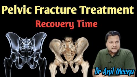 Pelvic Fracture Recovery Time | pelvic Fracture Treatment | pelvic ...