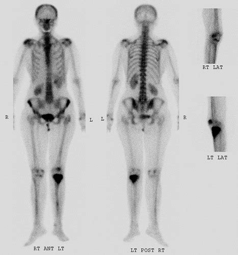 Renal Cell Carcinoma Manifesting as a Solitary Bone Metastasis | RadioGraphics