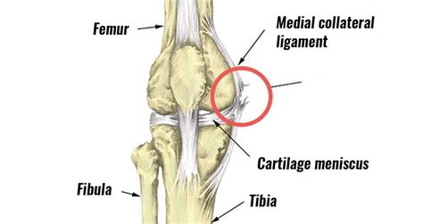 Medial Knee Ligament Sprain