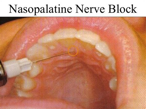 maxillary nerve blocks