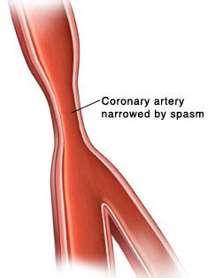 Coronary Artery Spasm | Saint Luke's Health System