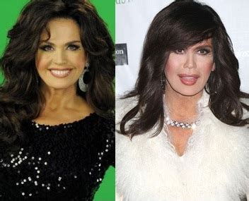 Marie Osmond Botox Plastic Surgery Before And After Face Photos | 2018 Plastic Surgery before ...