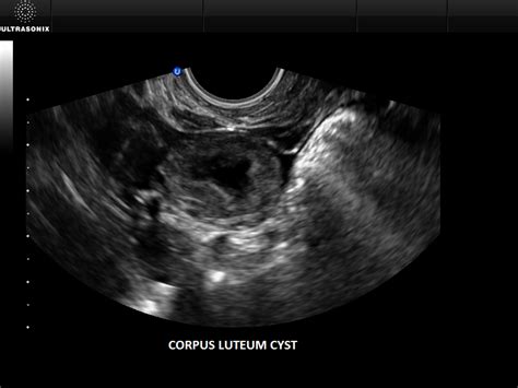 WK 4 L 2 corpus luteum cyst ultrasound - Google Search | OB/Gyn ...