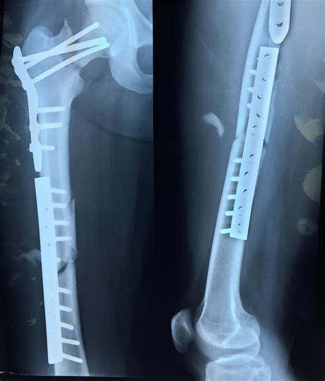 Left femoral neck fracture - maleAslo