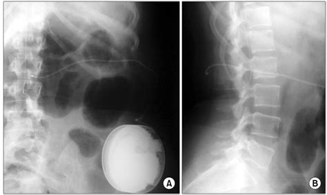 AP (A) and lateral (B) images of intrathecal catheter and implanted pump. | Download Scientific ...