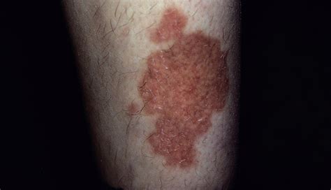 A spreading shin rash signifies systemic disease - Clinical Advisor