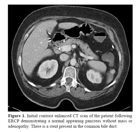 Adenocarcinoma of the Pancreas Undetected by Multidetector CT, En