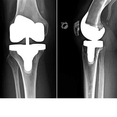 IMPLANT ATLAS — Hip & Knee Book