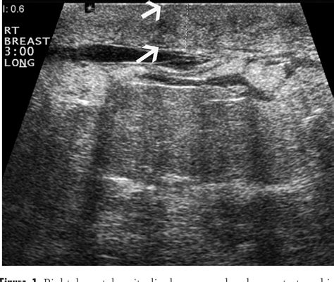 Sonographic features of inflammatory breast cancer. | Semantic Scholar