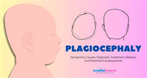 Understanding Plagiocephaly: Symptoms, Causes, Diagnosis, Treatment Options, and Potential ...