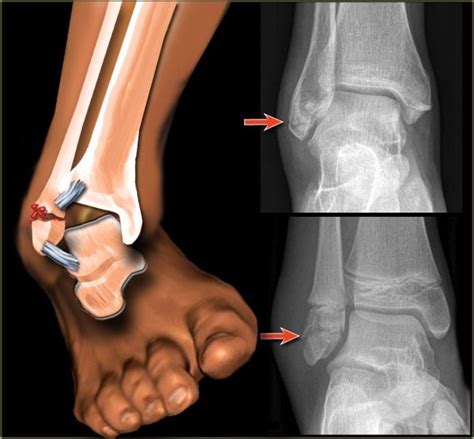 After Two Weeks, This Is What My Ankle Looks Like | Anatomía del tobillo, Fractura de tobillo ...