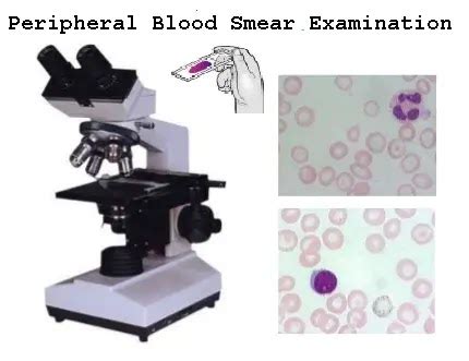 Examination of the Peripheral Blood smear