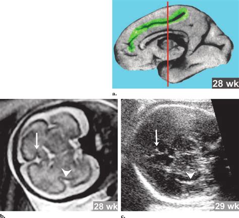 Cingulate sulcus. (a) Photograph of the medial hemispheric surface of ...