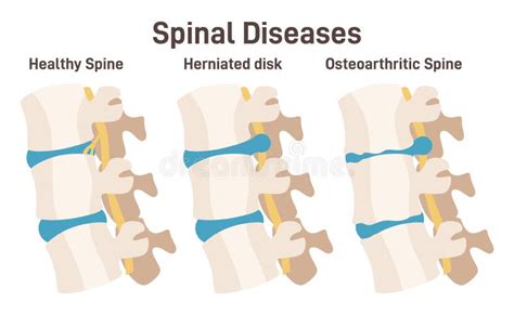 Spine Vertebrae Anatomy Scheme. Healthy Lumbar and Back Pain Causes ...