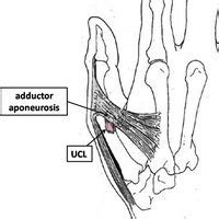 Skier's thumb - Physiopedia