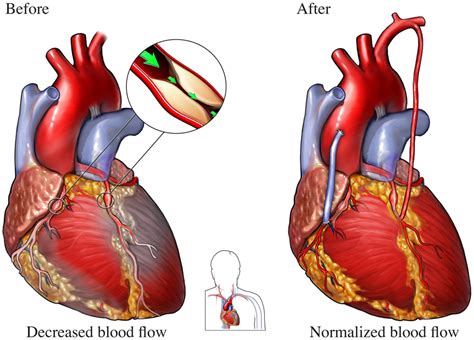 Coronary Artery Bypass Grafting | NHLBI, NIH