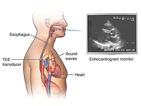 TEE Transesophageal Echocardiogram | Advanced Cardiovascular Clinic