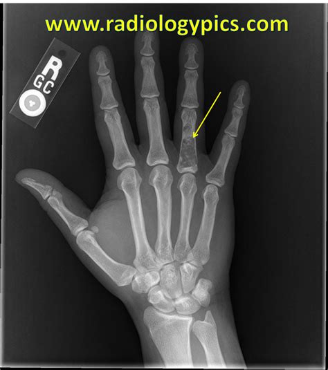 Enchondroma - frontal radiograph of the right hand reveals a lytic ...