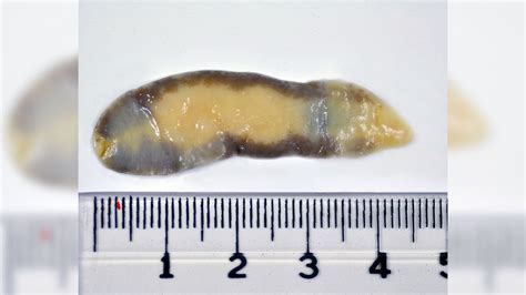 What Do Roundworms Look Like In Human Stool - Infoupdate.org