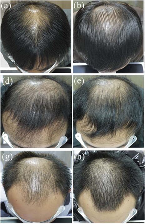 Finasteride Results: Timeline, Photos, Before & After