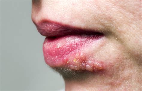 Herpes: o que é, sintomas, transmissão - Mundo Educação